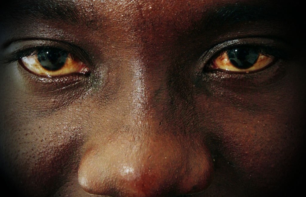 Causes of Red Eyes in the African